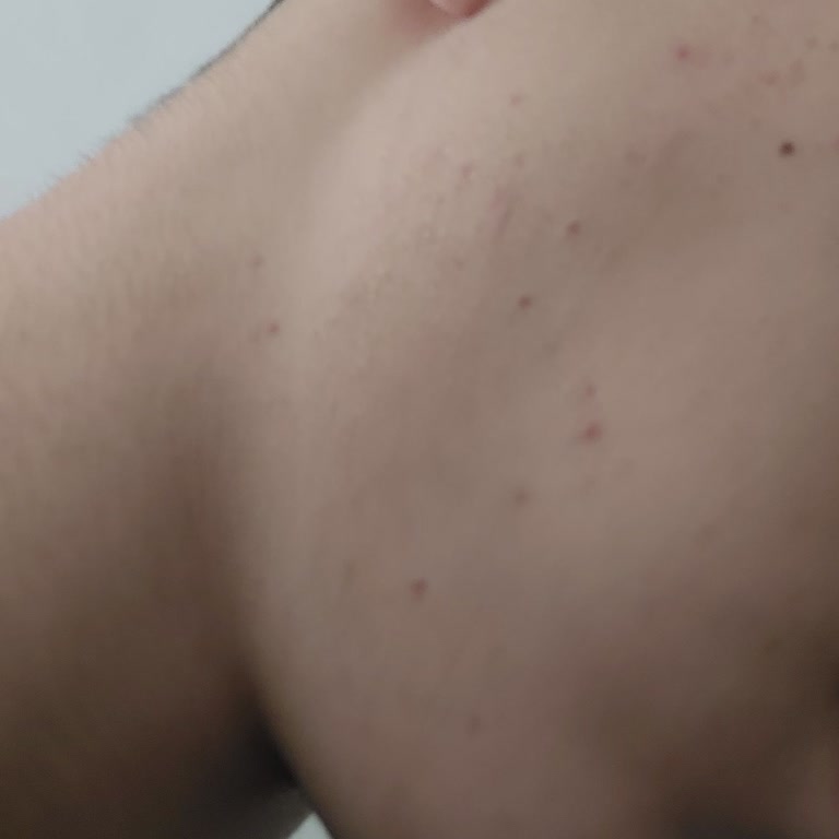 La Roche - Posay Cilt Yanması Ve Sivilce Sorunu