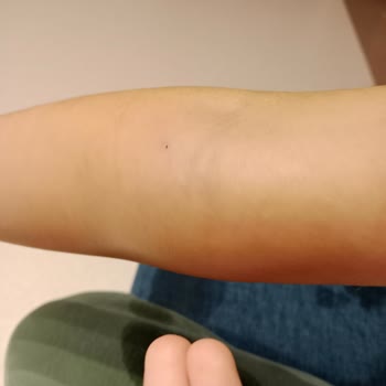 Acil Serviste İhmal: Kızımın Damarını Patlattılar!