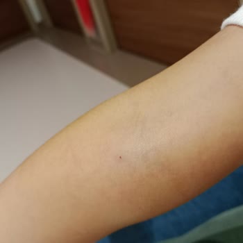 Acil Serviste İhmal: Kızımın Damarını Patlattılar!