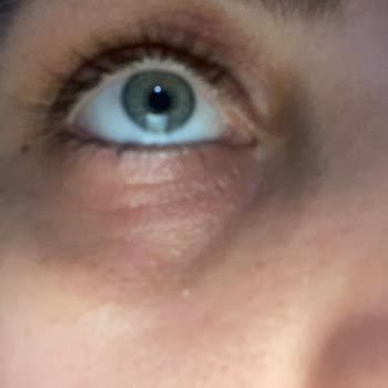 Kiehl's Vitamin C Eye Serum Caused Severe Reaction on Sensitive Skin