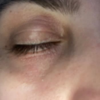 Kiehl's Vitamin C Eye Serum Caused Severe Reaction on Sensitive Skin
