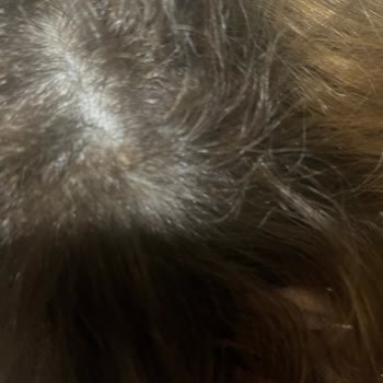 Palette 7.3 Hair Dye Caused Severe Scalp Burns and Pain