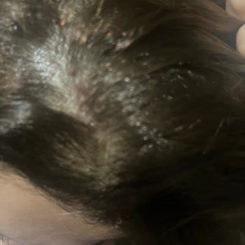 Palette 7.3 Hair Dye Caused Severe Scalp Burns and Pain