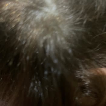 Palette 7.3 Hair Dye Caused Severe Scalp Burns and Pain