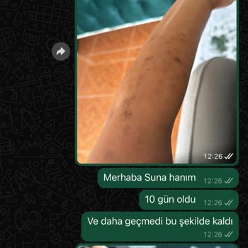 Lazer Epilasyon Sonrası Kalıcı Yanık İzleri Ve İlgisizlik