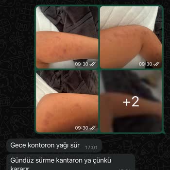Lazer Epilasyon Sonrası Kalıcı Yanık İzleri Ve İlgisizlik