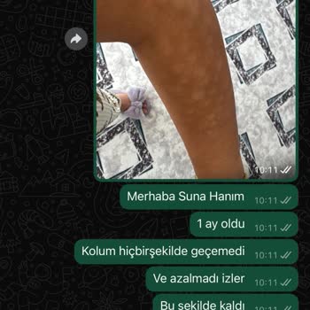 Lazer Epilasyon Sonrası Kalıcı Yanık İzleri Ve İlgisizlik