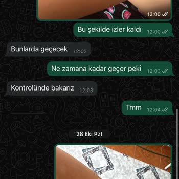 Lazer Epilasyon Sonrası Kalıcı Yanık İzleri Ve İlgisizlik