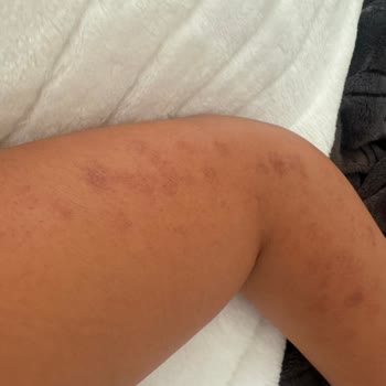 Lazer Epilasyon Sonrası Kalıcı Yanık İzleri Ve İlgisizlik