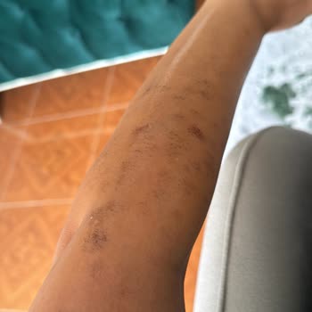 Lazer Epilasyon Sonrası Kalıcı Yanık İzleri Ve İlgisizlik