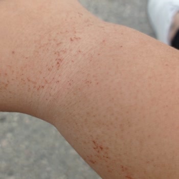 Lazer Epilasyon Deneyiminde Ciddi Sorunlar Ve İlgisizlik