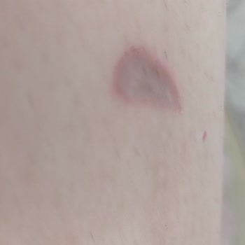 Lazer Epilasyon Deneyiminde Ciddi Sorunlar Ve İlgisizlik