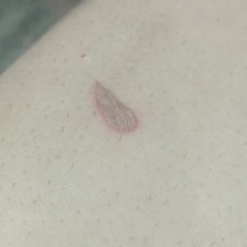 Lazer Epilasyon Deneyiminde Ciddi Sorunlar Ve İlgisizlik