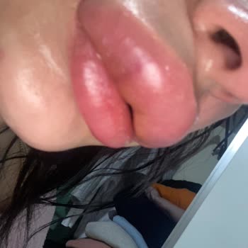 Zeyn Güzellik Merkezi'nde Dudak Dolgusu İşlemi Sonrası Mağduriyet!