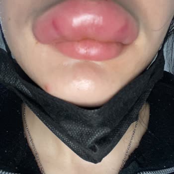 Zeyn Güzellik Merkezi'nde Dudak Dolgusu İşlemi Sonrası Mağduriyet!