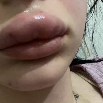 Zeyn Güzellik Merkezi'nde Dudak Dolgusu İşlemi Sonrası Mağduriyet!