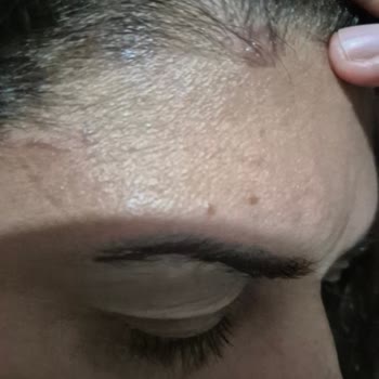 Saç Boyası Kullanımı Sonrası Cilt Yanığı Ve İlgisizlik