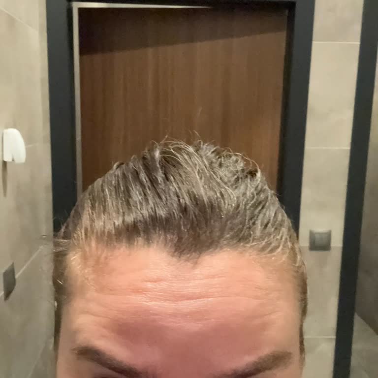 Botox Sonrası Hayal Kırıklığı Ve Yetersiz Hizmet