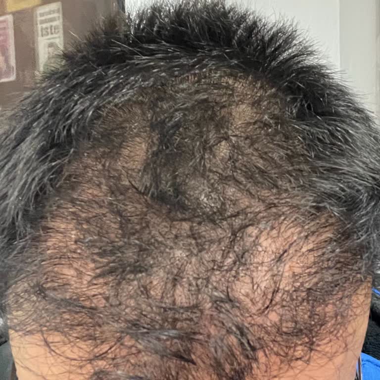 Op. Dr. Ali Tuncer Saç Ekiminden 10 Ay Sonrasında Sonuç Çok Kötü!