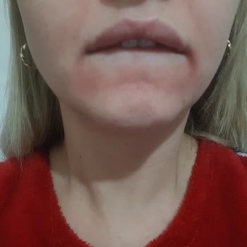 La Roche Posay Ürünleri Cilt Sorunlarına Yol Açtı