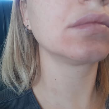 La Roche Posay Ürünleri Cilt Sorunlarına Yol Açtı