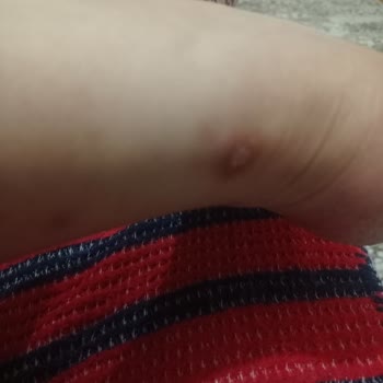 Ayakkabının Rahatsız Edici Vuruş Sorunu