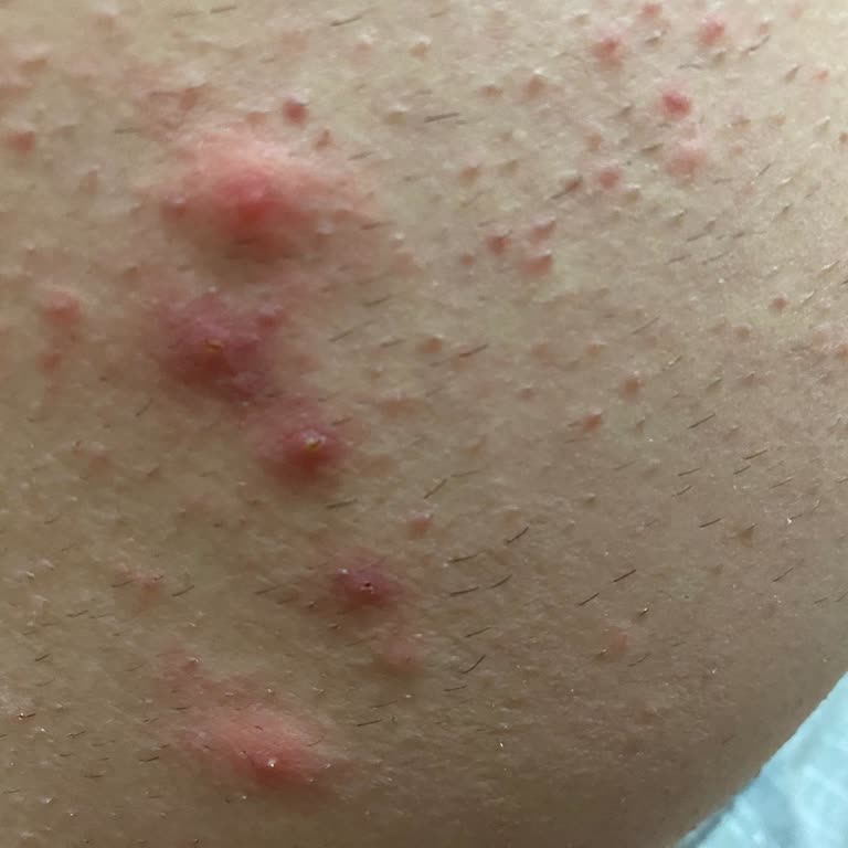 Veet Hair Removal Cream Caused Severe Skin Reactions and Rashes