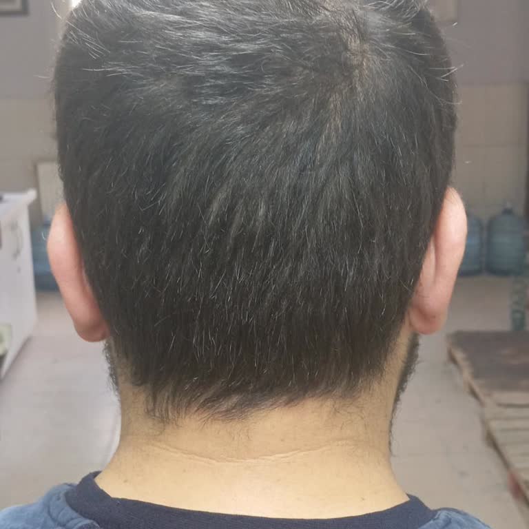 Selda Hair Center Saç Ekimi Sonrası Hayal Kırıklığı Ve İlgisizlik