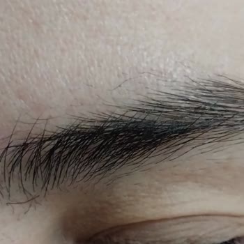 Özensiz Lazer Uygulaması Yüzünden Yanan Saçlar Ve Kaşlar