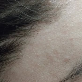 Özensiz Lazer Uygulaması Yüzünden Yanan Saçlar Ve Kaşlar