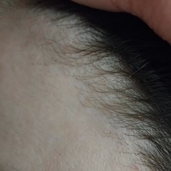 Özensiz Lazer Uygulaması Yüzünden Yanan Saçlar Ve Kaşlar