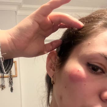 Yves Rocher Ürünü Cilt Sorunlarına Yol Açtı