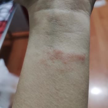 Huawei Saat Kordonu Alerjik Reaksiyon Sorunu