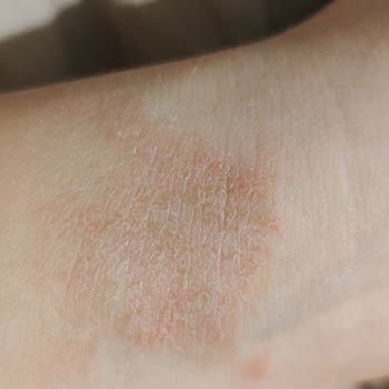 Huawei Saat Kordonu Alerjik Reaksiyon Sorunu