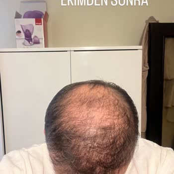 Suat Çiçek Eshair Saç Ekimi Sorunu: Yüksek Ücret, Hayal Kırıklığı Ve Haksız Talepler!