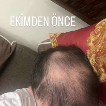 Suat Çiçek Eshair Saç Ekimi Sorunu: Yüksek Ücret, Hayal Kırıklığı Ve Haksız Talepler!