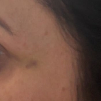 Hayal Kırıklığına Uğratan Botox Deneyimi