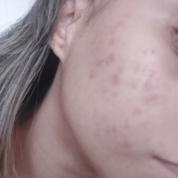 Maruderm Yanlış Ürün Kullanımı Yüzünden Cilt Sorunları