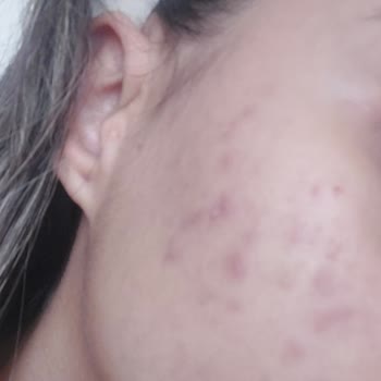 Maruderm Yanlış Ürün Kullanımı Yüzünden Cilt Sorunları