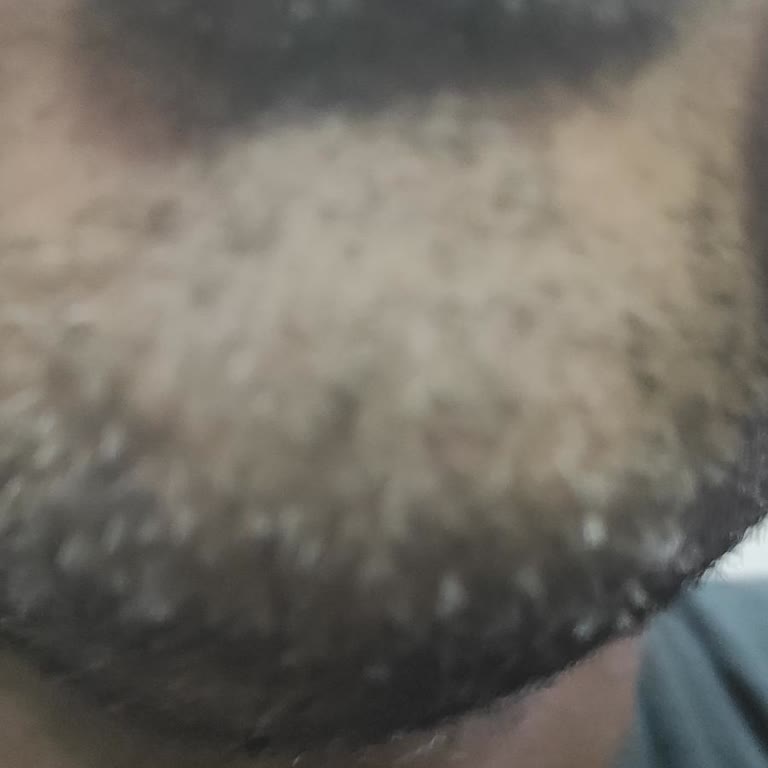 Sensodyne Sensitivity & Gum Toothpaste Caused Mouth Irritation and Sores