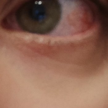 Sinoz Yanlış Ürün Kullanımı Sonrası Görme Problemi