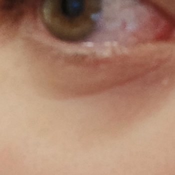 Sinoz Yanlış Ürün Kullanımı Sonrası Görme Problemi