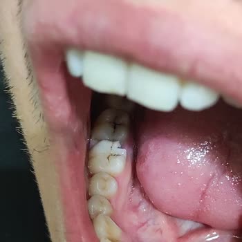 Üründe Yabancı Madde Tehlikesi