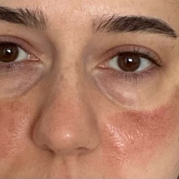 Yetersiz Hizmet Ve Maddi Kayıp: Cilt Lekesi Tedavisinde Hayal Kırıklığı