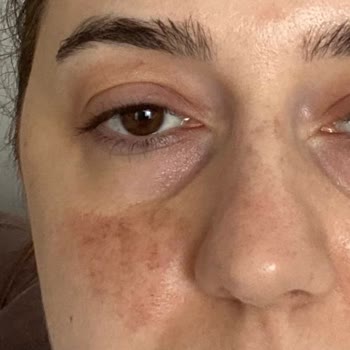 Yetersiz Hizmet Ve Maddi Kayıp: Cilt Lekesi Tedavisinde Hayal Kırıklığı