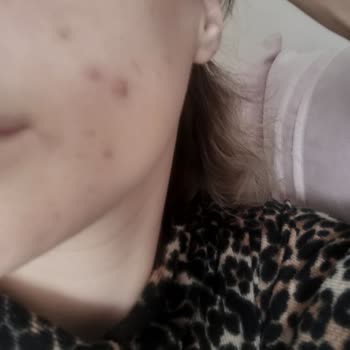 La Roche - Posay Duo +m Krem Sivilce Sorunu