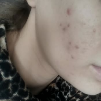 La Roche - Posay Duo +m Krem Sivilce Sorunu