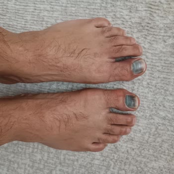 Yanlış Numara Ve Standart Dışı Kalıplar Ayak Sağlığımı Tehdit Ediyor