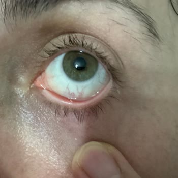 Lasik Ameliyatı Sonrası Kalıcı Sorunlar Ve İlgisiz Doktor Tavrı