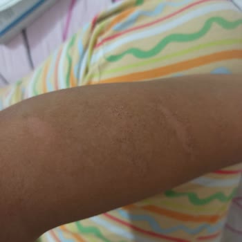 Epi Center Güzellik Lazer İşlemi Sırasında Vücudumu Yaktı